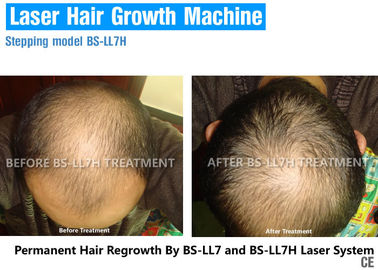 Thiết bị phục hồi tóc bằng laser mật độ cao với mức năng lượng điều chỉnh 650nm / 670nm