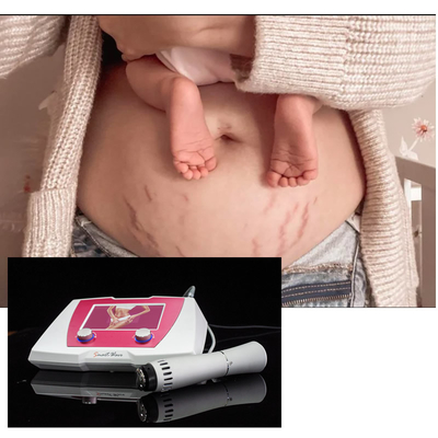 Salon sử dụng máy điều trị sóng âm thanh để điều trị cellulite cơ bắp thư giãn máy làm đẹp BS-SWT2X