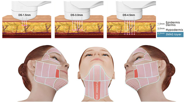 Vertical Stationary HIFU Beauty Machine For Face Lifting / Wrinkle Removal
